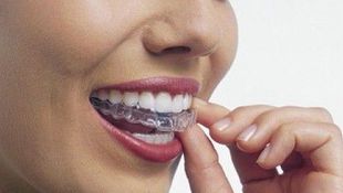 Imagen de Tratamientos - Ortodoncia estética