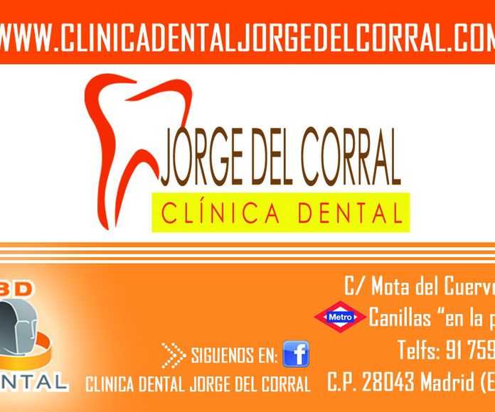 Carillas Dentales en Hortaleza - Clínica Orgaz Dental