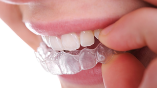 Imagen de SERVICIOS - Ortodoncia invisible