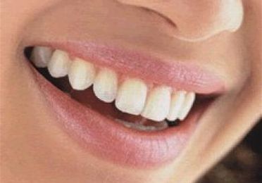 Gingivoplastia