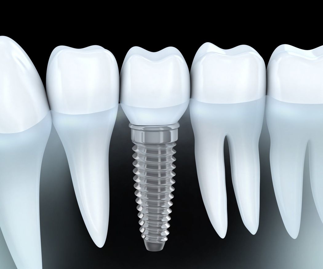 Mitos sobre los implantes dentales