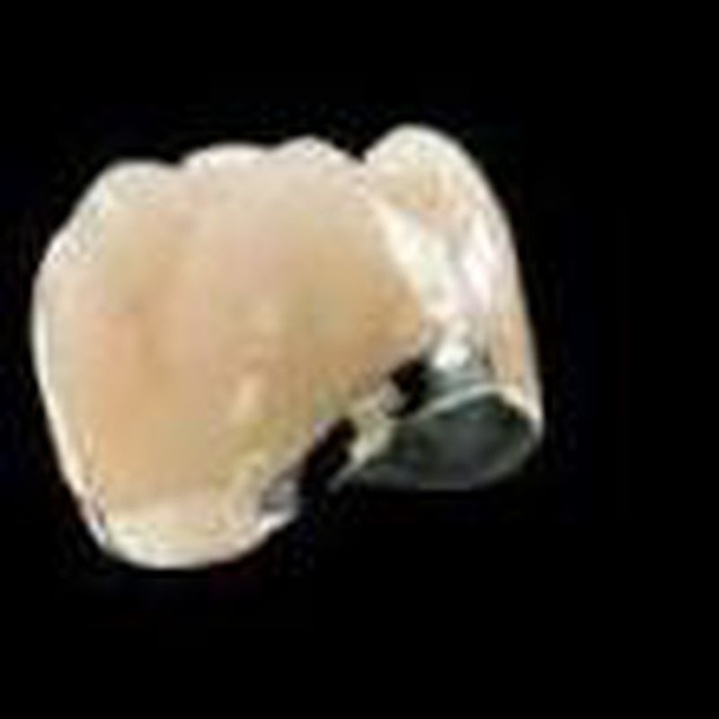 Corona metal porcelana: Tratamientos de Clínica Dental Tucán