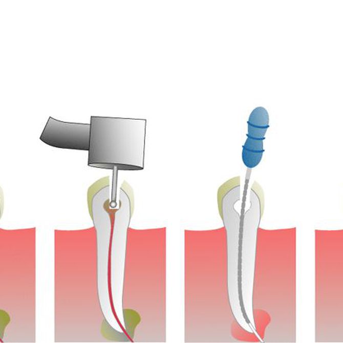 Ventajas de hacerse una endodoncia