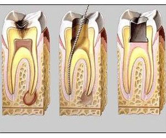 Endodoncia: Odontología: servicios de Clínica  Dental Leticia Lenguas