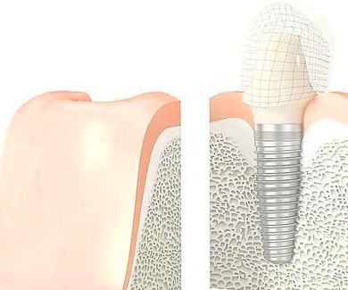 La naturalidad, el último reto de los implantes dentales