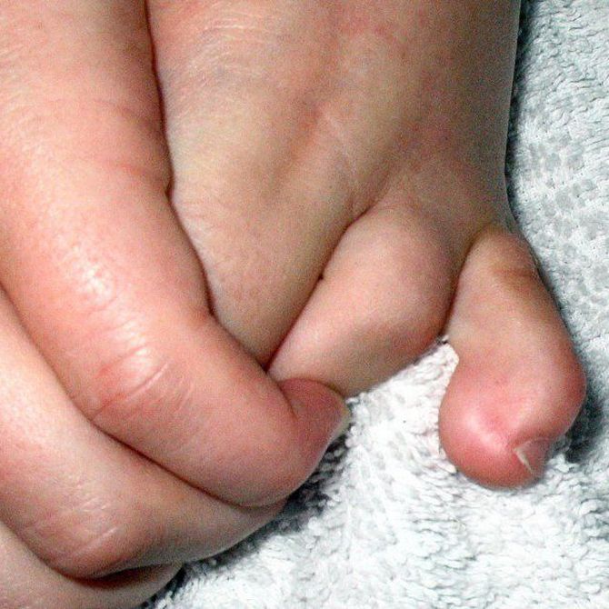 Dolorosas deformaciones en los dedos del pie: dedos en garra