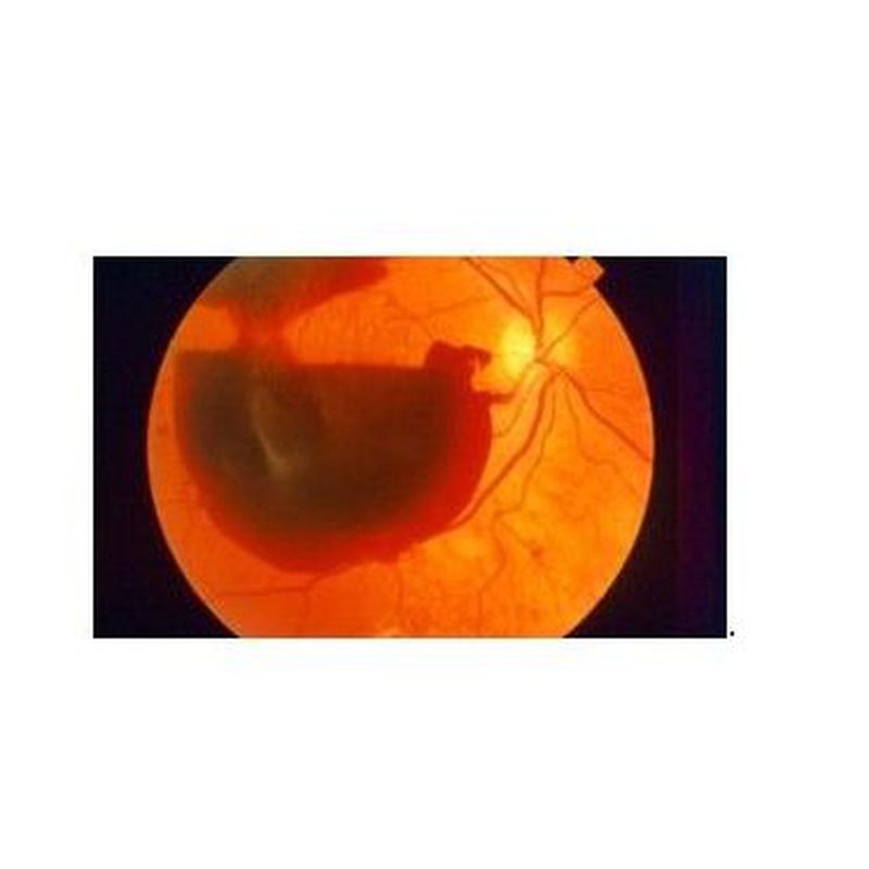Retinopatía diabética: Patologías oculares de Oftalmólogo Cristina Mantolán Sarmiento