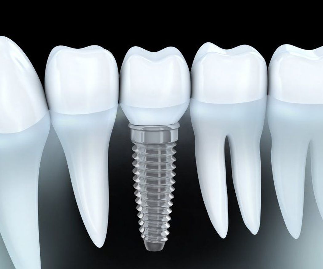 Implantes dentales ¡La solución definitiva para una sonrisa saludable!