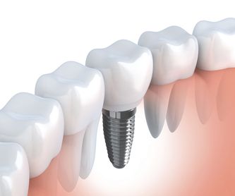 Prótesis dental: Especialidades odontológicas de Clínica Dental Gil Nieto