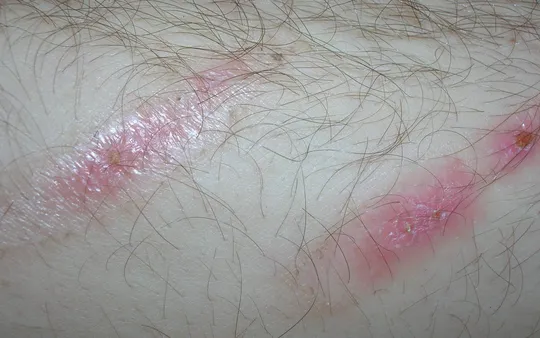 Enfermedades de la piel