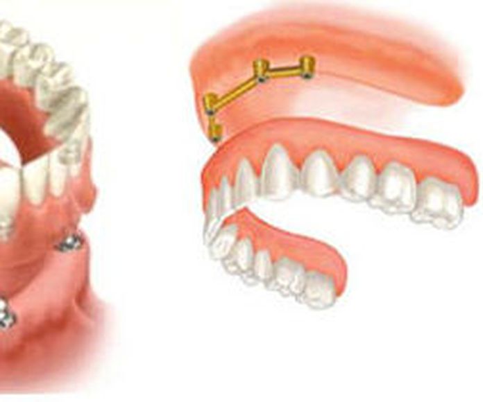 Implantes dentales, dentadura completa sobre implantes: Tratamientos de Clínica dental Neardental }}