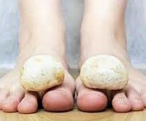 diagnostico de hongos en uñas , o planta del pie