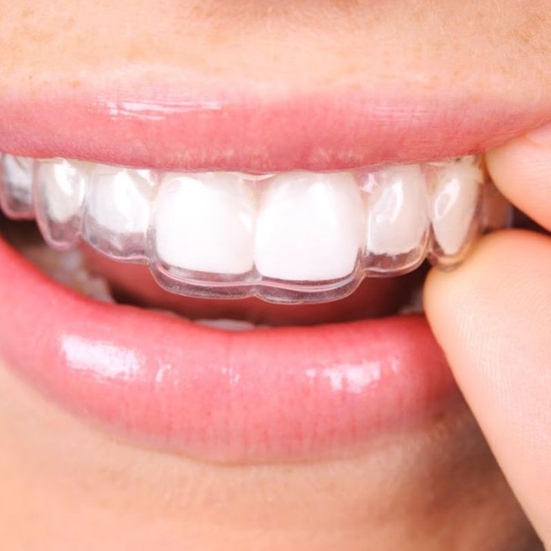 Ortodoncia invisible: Servicios de CEO Clínica Dental