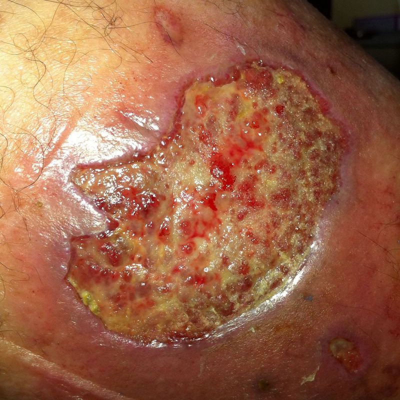 Úlceras: Productos y servicios de Consulta Barreiro-Vascular (Dr. A. Barreiro Mouro)
