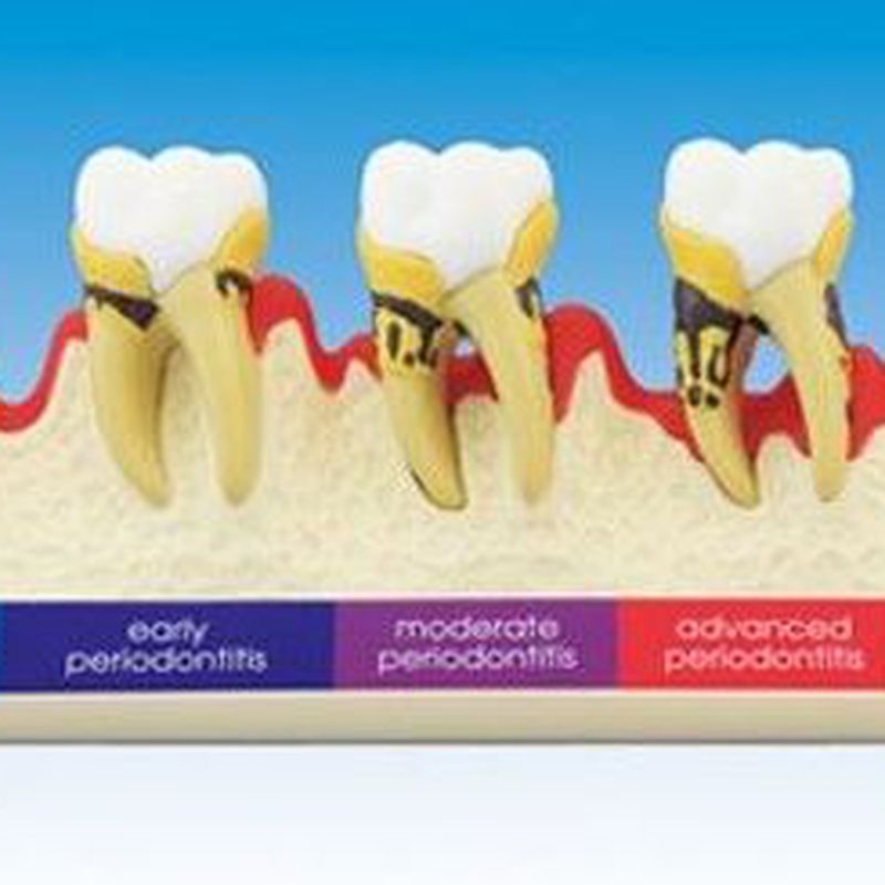 Evolución enfermedad periodontal en molares