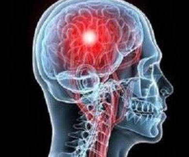 Accidente cerebrovascular: Una mirada fonoaudiológica