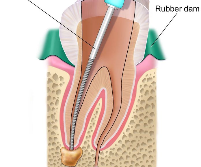 Endodoncia: Servicios de Clínica Dental Gándara