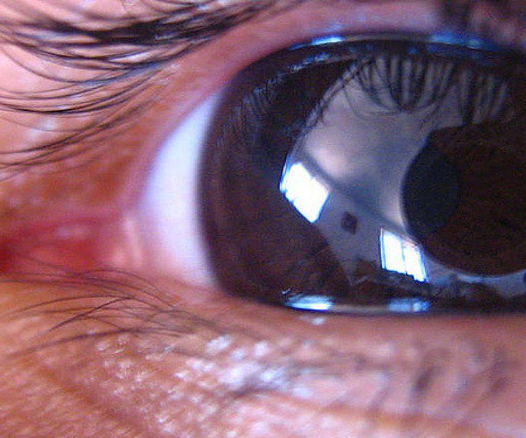 ¿Se puede eliminar el glaucoma?