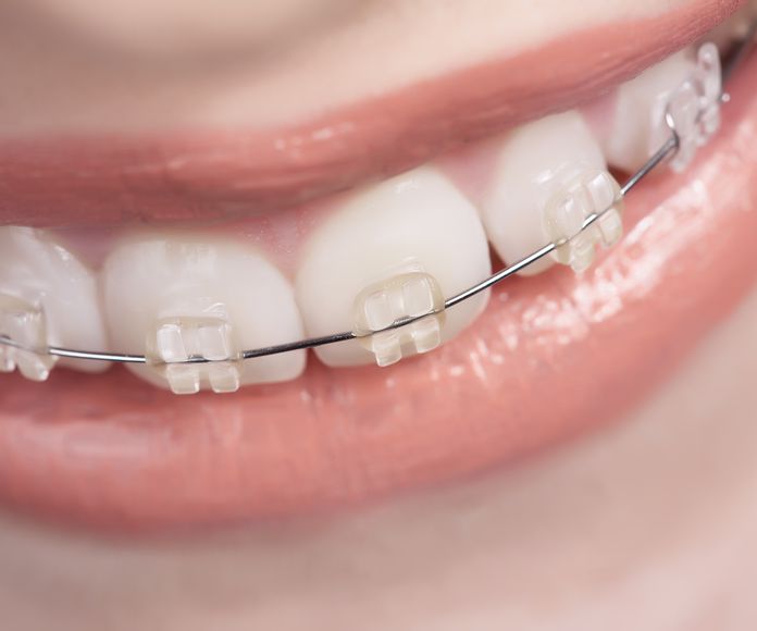 Ortodoncia fija : Especialidades  de Clínica Dental Baviera