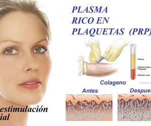 Plasma rico en plaquetas (Hidratación y Capilar)