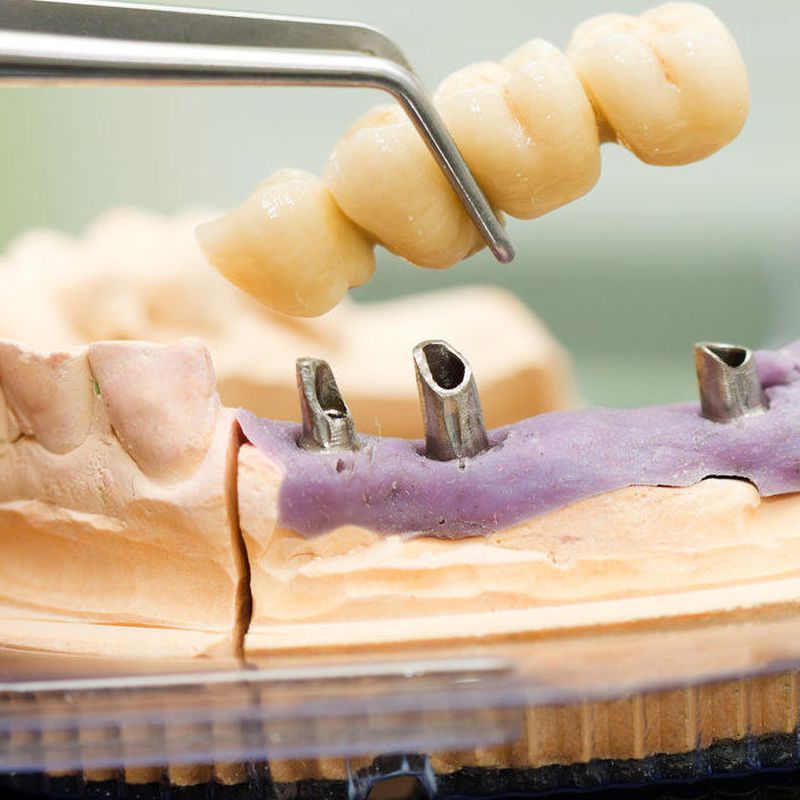 Implantes: Tratamientos de Clínica Dental Herpaden