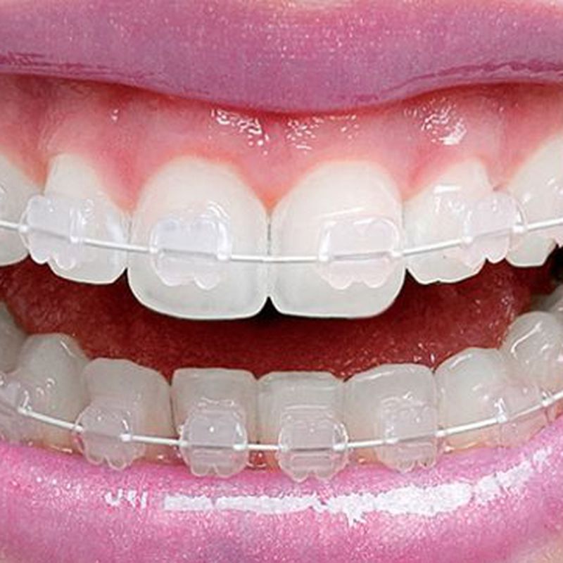Ortodoncia: Tratamientos de Dental Valls
