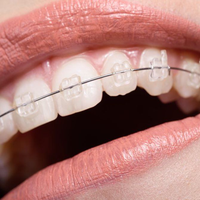 Ortodoncia: consigue la sonrisa perfecta
