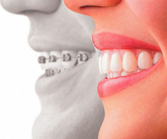 Ortodoncia invisible Invisalign®: Tratamientos de Trabajamos con las principales mutuas y aseguradoras de salud }}