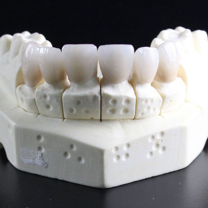 ¿Qué debemos tener en cuenta a la hora de colocar implantes dentales?