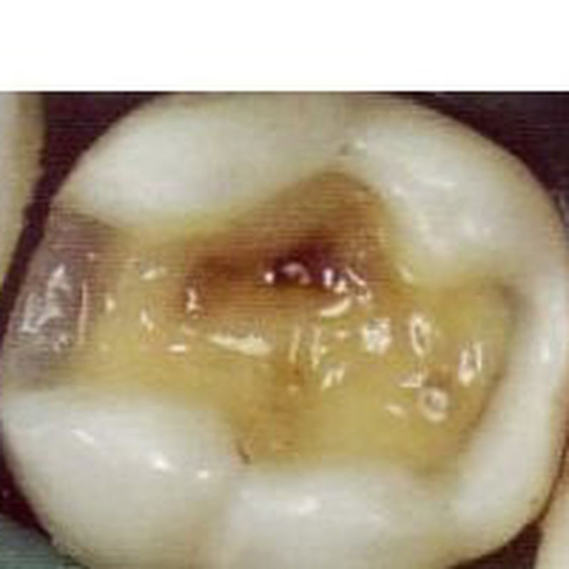 Empastes : Servicios   de Clínica Dental Dr. Javier Pérez Martínez N.I.C.A. 27795