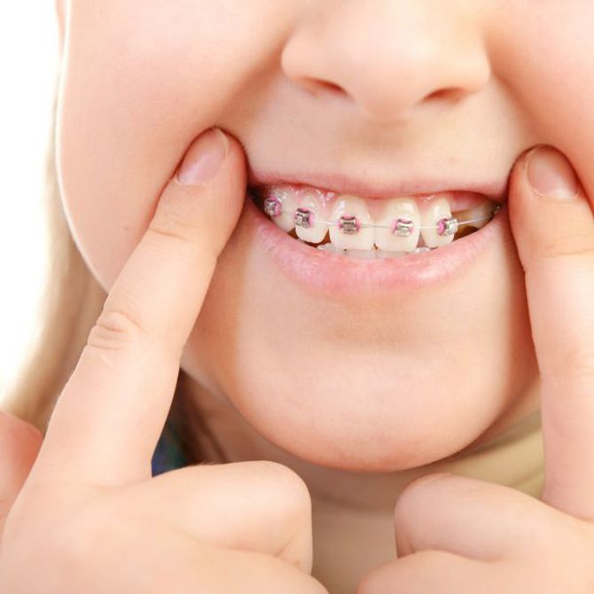 A partir de qué edad se puede usar ortodoncia