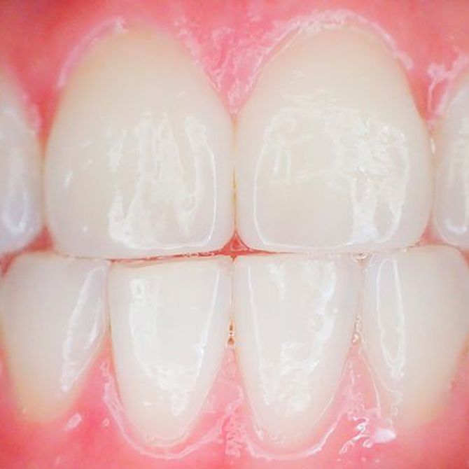 ¿Por qué pueden salir manchas blancas en los dientes?