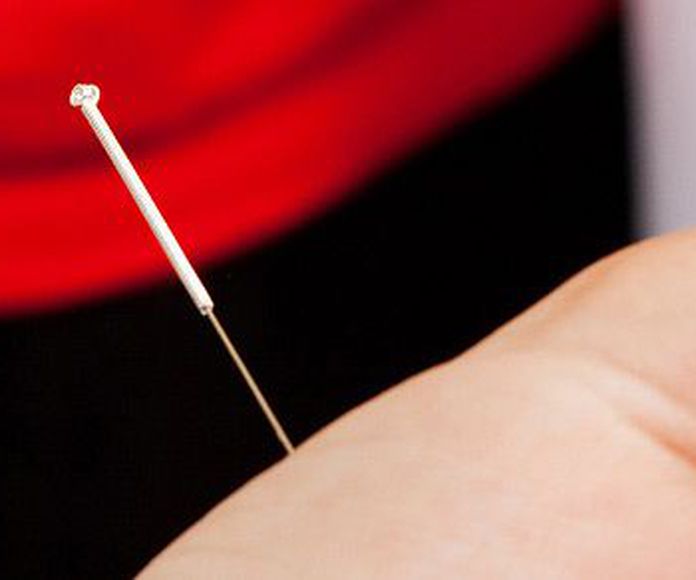 Punción seca: Tratamientos de Fisioterapia Fis & Fit