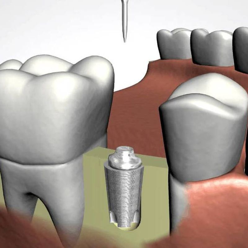 Implantes dentales: Especialidades de Clínica Dental Castellbisbal