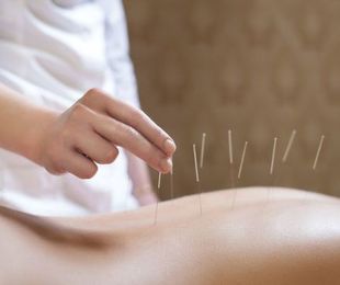 Acupuntura