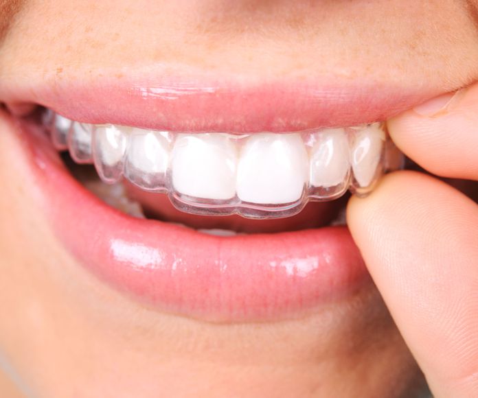 Ortodoncia invisible: Especialidades  de Clínica Dental Vistalegre }}