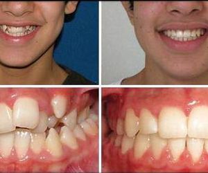 Resultados ortodoncia Damon Basauri