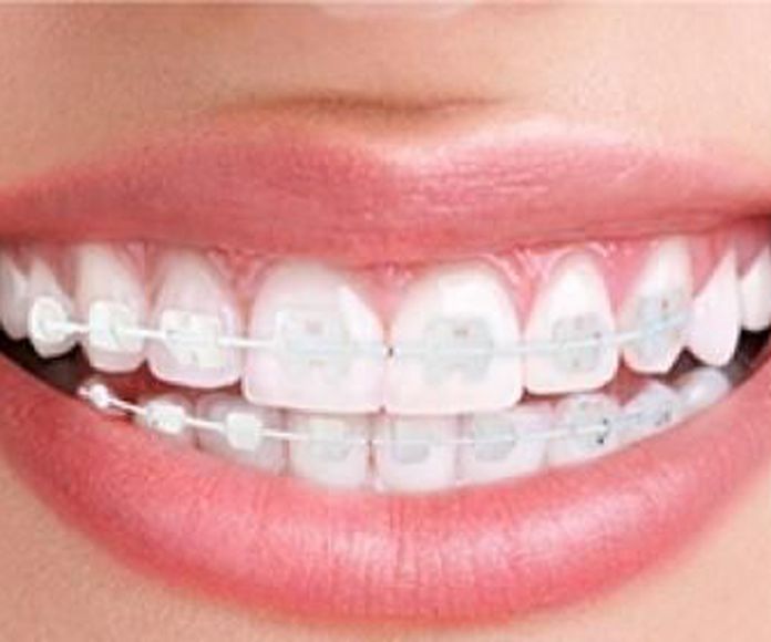 Ortodoncia convencional: Tratamientos de Clínica Dental Ruiz Jalón }}