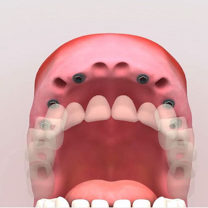 ¿Qué fases tiene un procedimiento con implantes dentales?