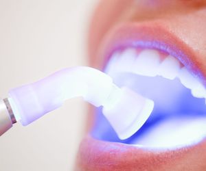 Consejos a seguir tras un blanqueamiento dental
