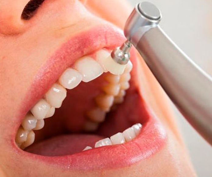 Limpieza bucal: Especialidades de Clínica Dental Dr. Yagüe