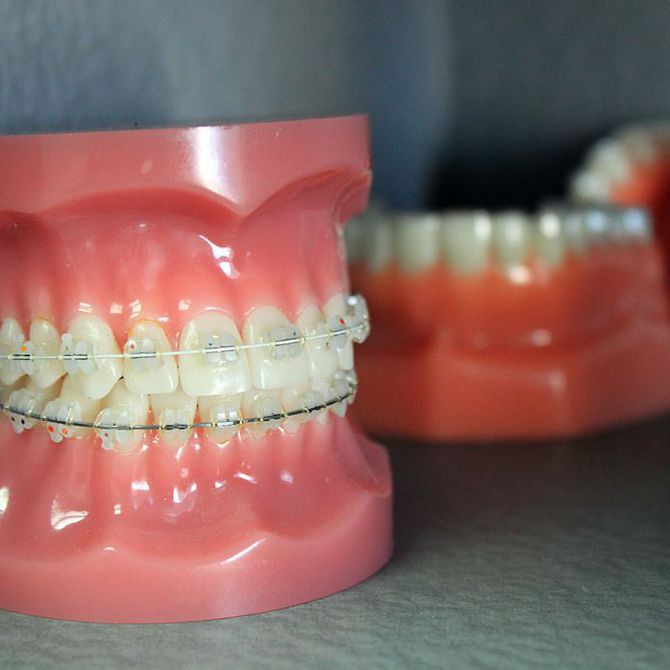 Los beneficios para la salud de las ortodoncias