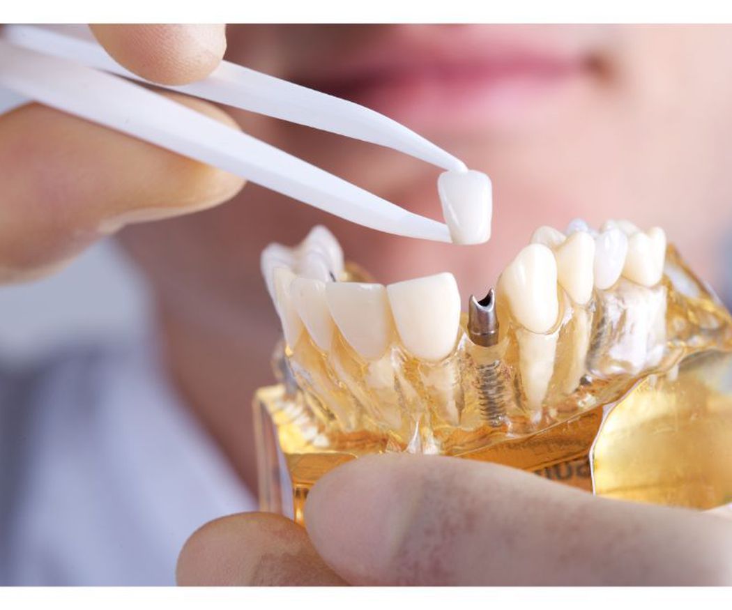 Cuidados antes y después de ponerse implantes dentales