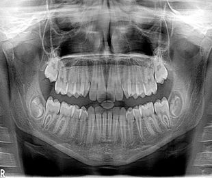 La utilidad de las radiografías dentales