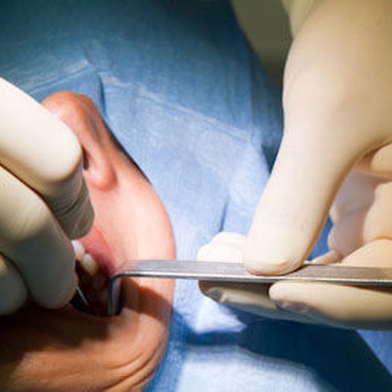 Cirugía bucal: Tratamientos de Clínica Dental Dr. de la Torre