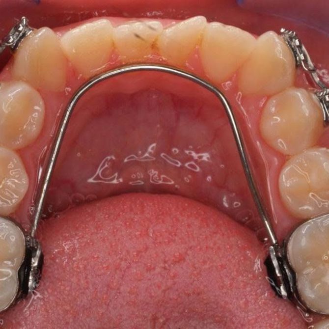 La ortodoncia lingual: sus características