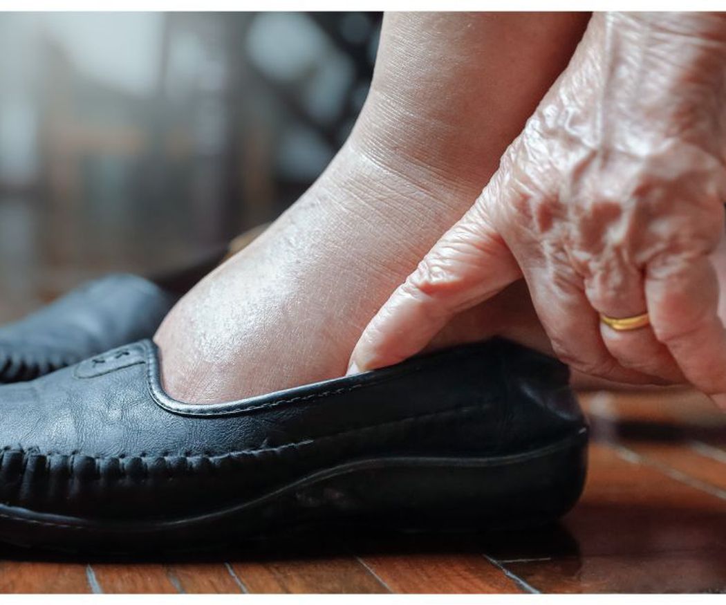 Patologías de los pies de nuestros mayores