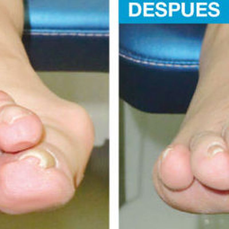 Problemas de dedos Menores: Cirugía del Pie de Clínica Podológica José Mª Pe Duarte