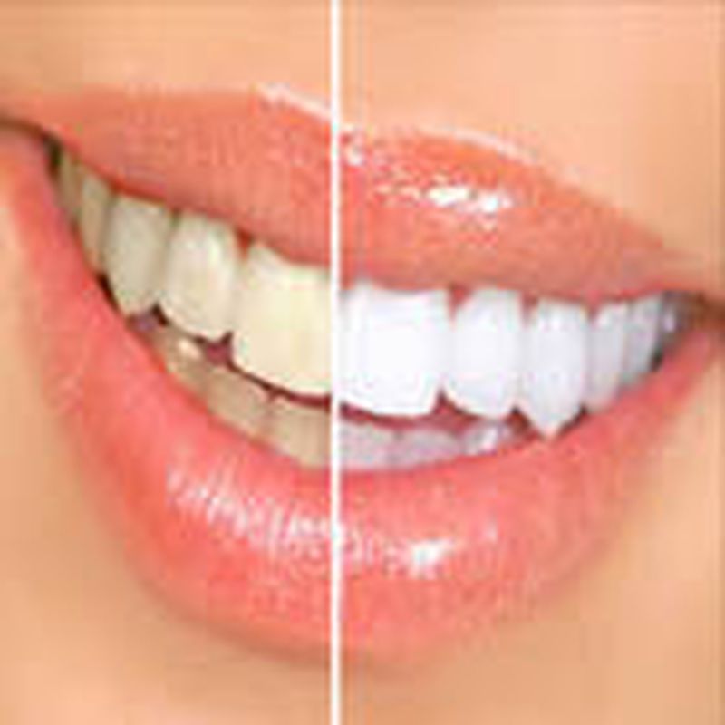 Estética dental: Servicios de Clínica Implanteoral Milladoiro