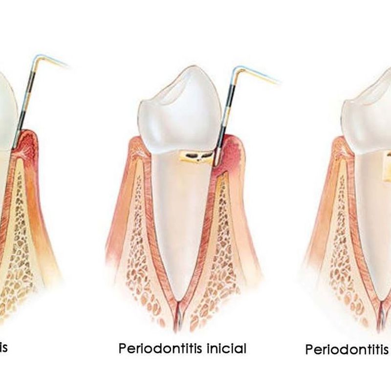 Secuencia enfermedad periodontal diente anterior
